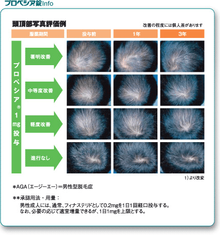 プロペシア錠info04